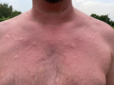 Mề đay do lạnh mùa đông được phân thành 4 loại nhưng chủ yếu vẫn là hai dạng chính là mề đay do lạnh mắc phải và mề đay do lạnh di truyền (Nguồn: Recodev.sfdermato.org)