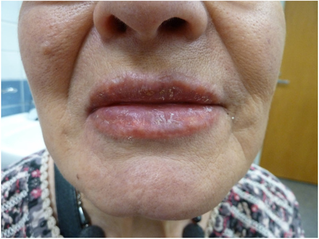 Viêm da tiếp xúc dị ứng mạn tính sau khi xăm môi