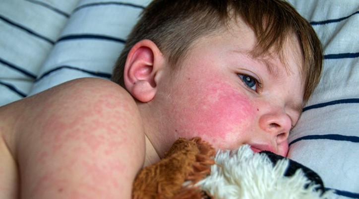  Triệu chứng và dấu hiệu dị ứng thức ăn khác nhau do tác nhân dị ứng và tuổi tác (Nguồn: Gruballergy)