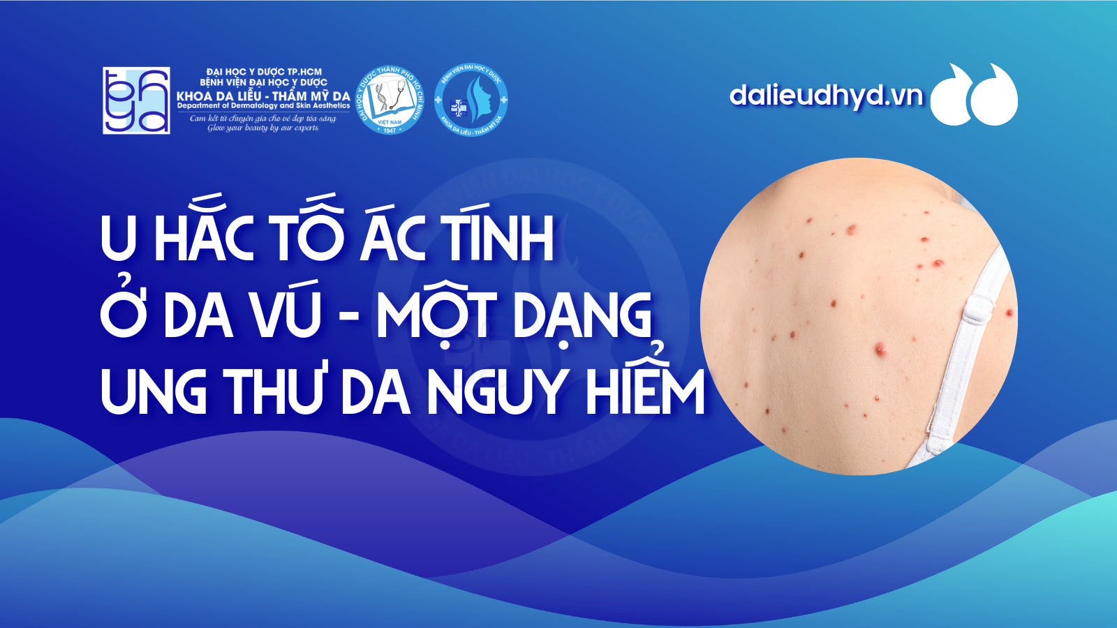 U hắc tố ác tính ở da vú - Một dạng ung thư da nguy hiểm