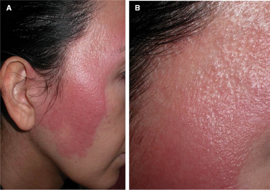 Bệnh viêm da tiếp xúc dị ứng do mỹ phẩm (Nguồn: Degruyterbrill)