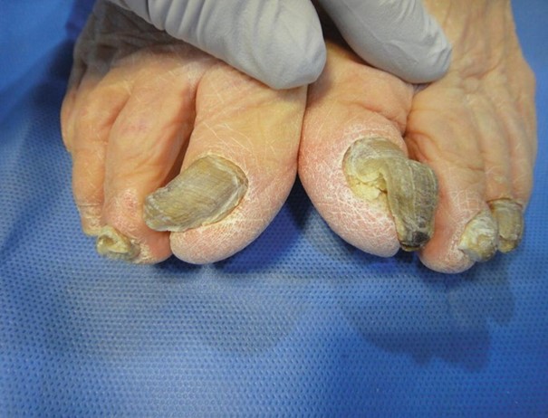 Hội chứng YNS khiến móng vàng do cả thói quen, lối sống lẫn mắc các loại bệnh liên quan đến hệ thống miễn dịch. (Nguồn: Link.springer)