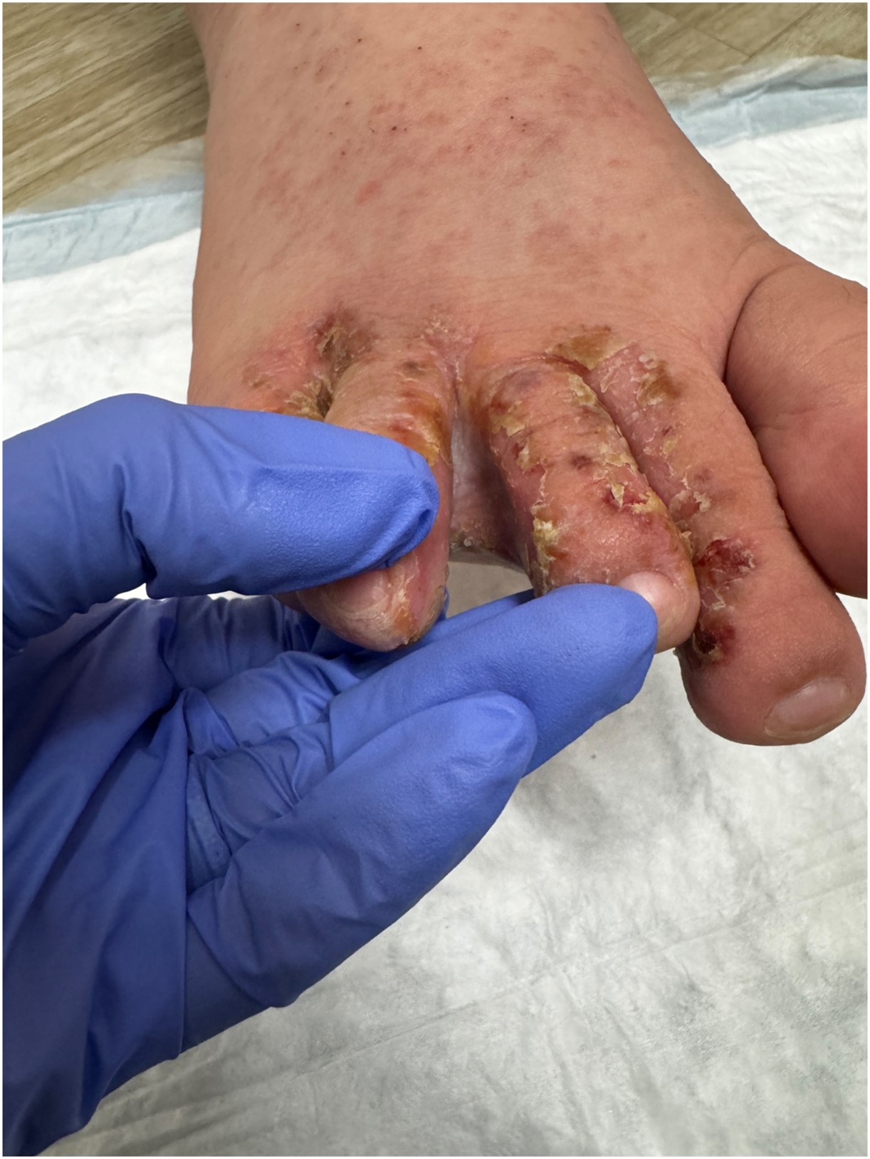 Bệnh nhiễm trùng da mạn tính hay viêm đỏ nếp kẽ do vi khuẩn gây ra các mảng da màu nâu đỏ, bong vảy, thường xuất hiện tại những vùng nếp gấp ẩm (Nguồn: Jpeds)