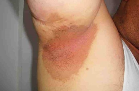 Bệnh Erythrasma hay nhiễm trùng da mạn tính là 1 trong 7 bệnh lý nhiễm trùng da do vi khuẩn phổ biến nhất (Nguồn: Stamfordskin)