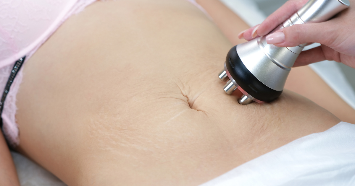 Các phương pháp điều trị rạn da tuổi dậy thì hiệu quả