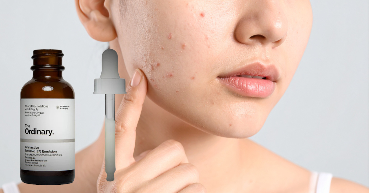 Cách trị mụn ẩn tại nhà hiệu quả, an toàn