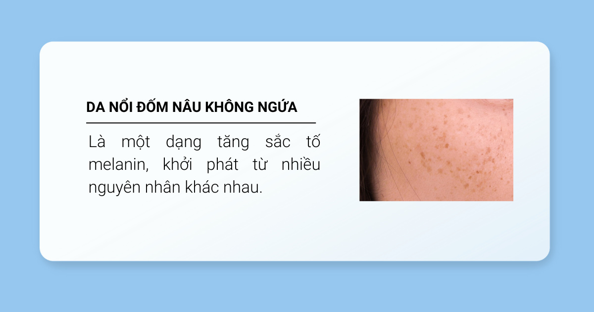 Da nổi đốm nâu không ngứa là gì