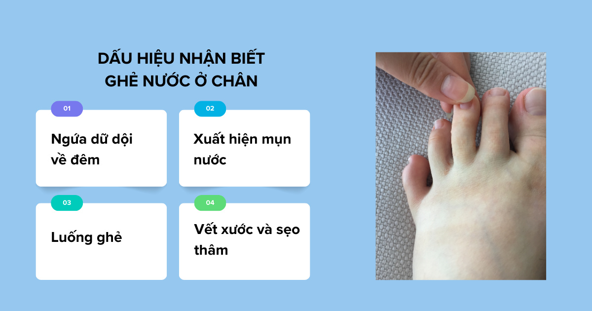 Dấu hiệu nhận biết ghẻ nước ở chân