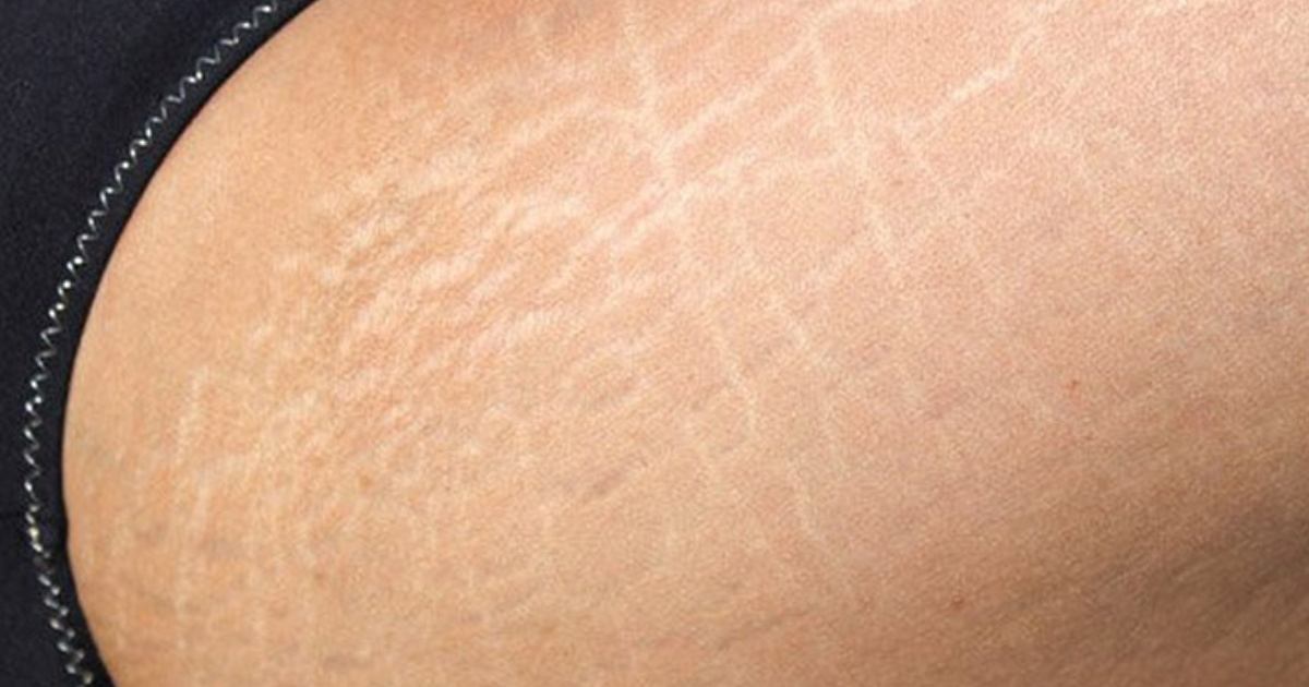 Dấu hiệu nhận biết rạn da ở tuổi dậy thì