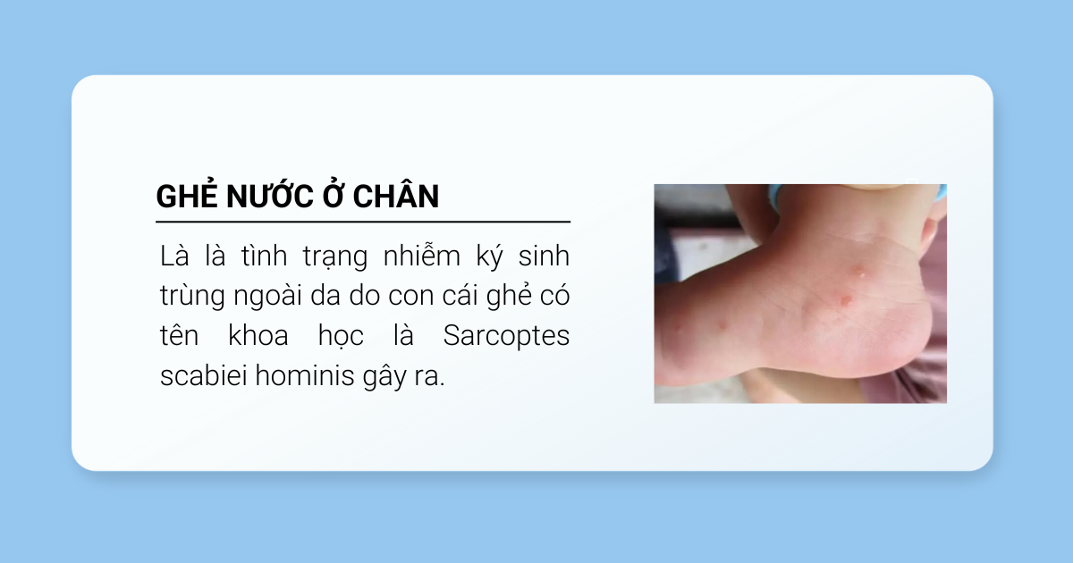 Định nghĩa ghẻ nước ở chân 