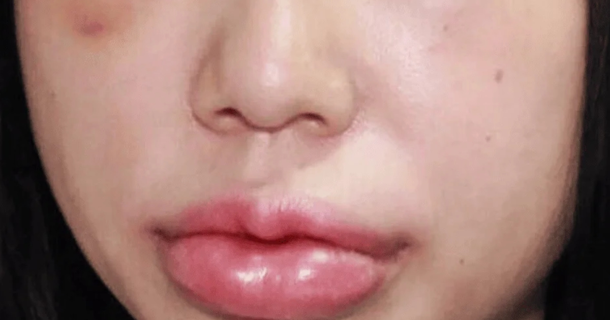 Khi nào cần tiêm tan filler