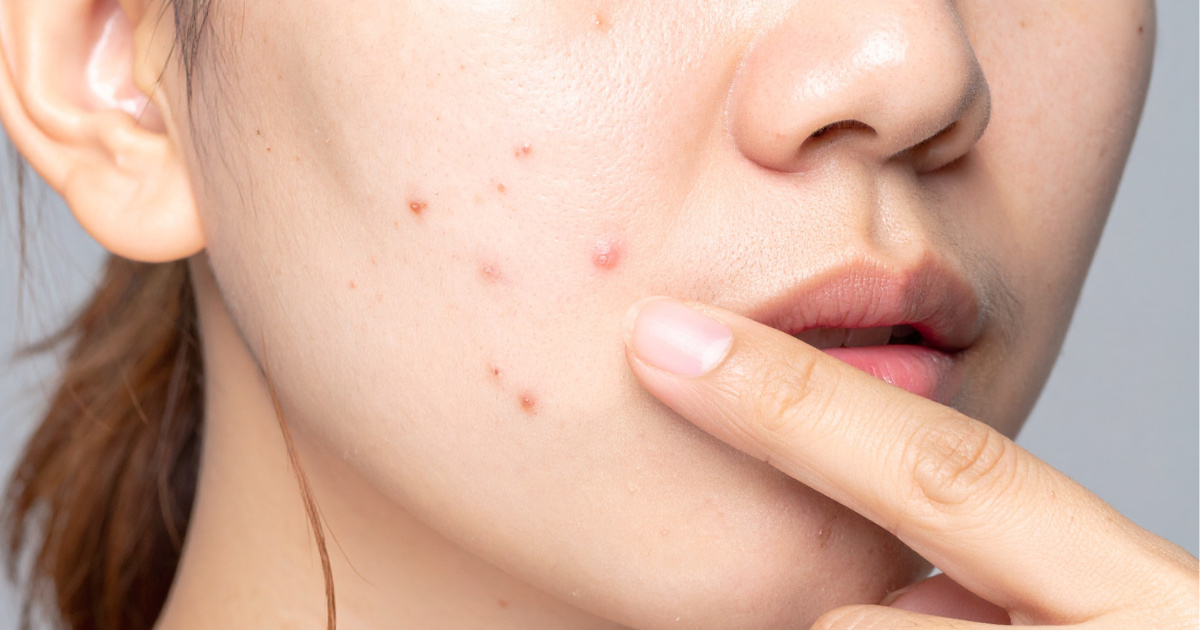 Cách điều trị mụn hiệu quả 