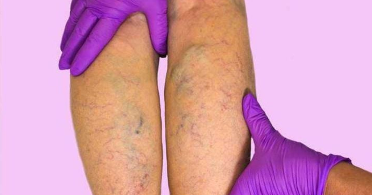 Mụn nhọt ở chân có nguy hiểm không