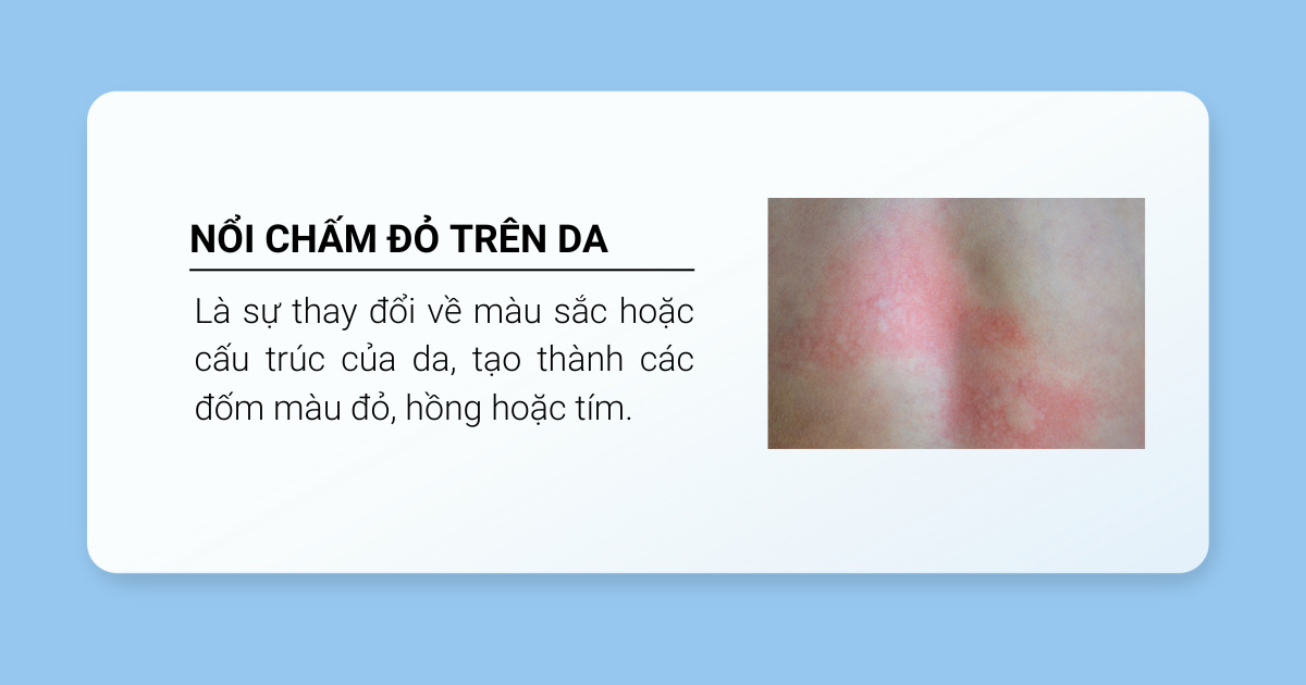 nổi chấm đỏ trên da là gì