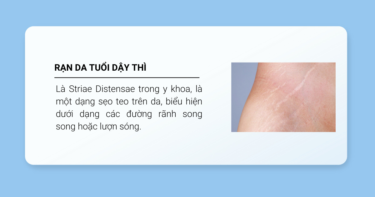 Rạn da tuổi dậy thì là gì