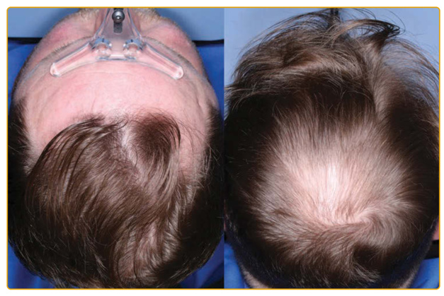 Rụng tóc do Androgen ở nam