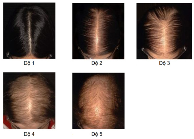 Rụng tóc do Androgen ở nữ