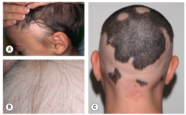 Rụng tóc từng vùng biểu hiện với mảng rụng tóc (hình A); Trong mảng rụng tóc có nhiều tóc dấu chấm than (hình B); Các vùng rụng tóc hình tròn và hợp lại với nhau, tạo nên kiểu rụng tóc dạng ophiasis (hình C).