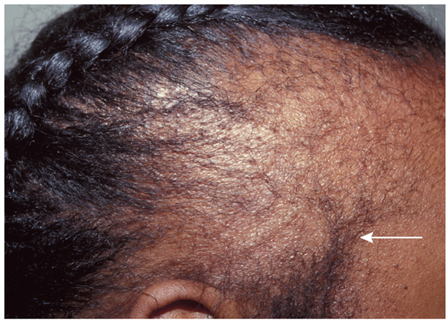 Thường gặp ở vùng trán–thái dương liên quan đến các kiểu tạo tóc gây chấn thương.