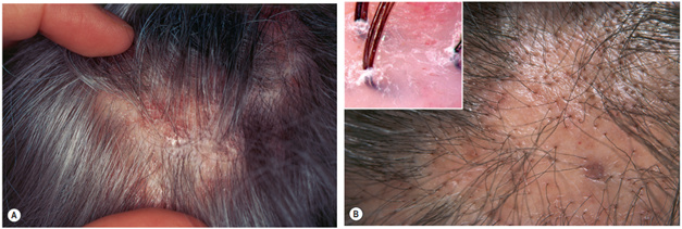 Lichen planopilaris. A. Các vùng rụng tóc rải rác, kèm hồng ban quanh nang lông và vảy ở rìa đang hoạt động. B. Giai đoạn muộn cho thấy sẹo hóa với mất các lỗ nang lông. Khi soi da đầu (trichoscopy), thấy vảy quanh nang lông và các vùng không còn lỗ nang lông (dạng chấm) do mất nang tóc (hình nhỏ kèm theo).