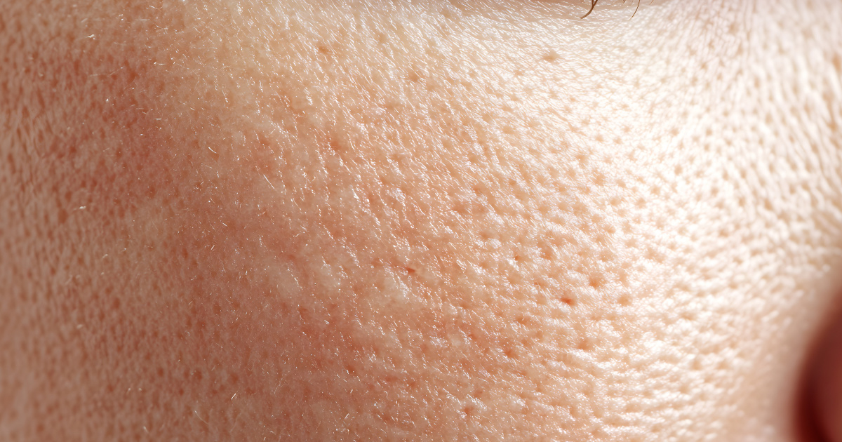 Tại sao lỗ chân lông ngày càng to?