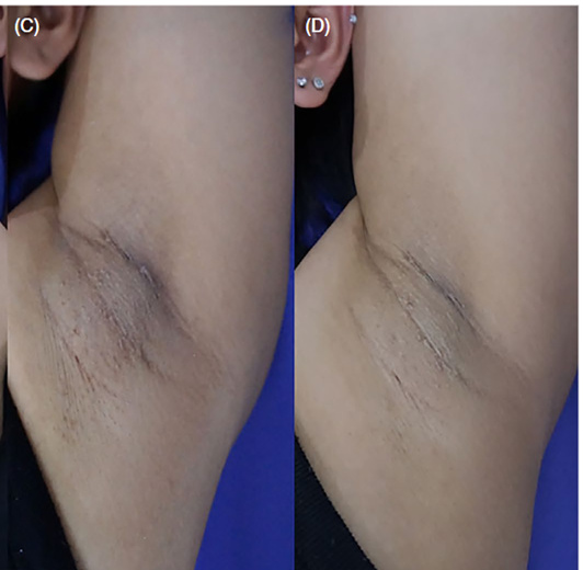 Kết quả điều trị sau 3 lần điều trị bằng Q-switched Nd:YAG 1064nm - Nguồn: Amornpetkul W, et al. 2021