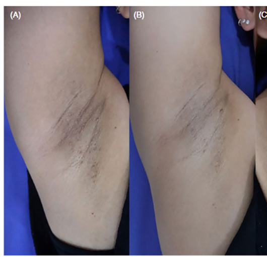 Kết quả điều trị sau 3 lần điều trị bằng IPL - Nguồn: Amornpetkul W, et al. 2021