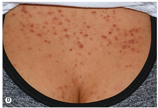 Viêm nang lông do Malassezia