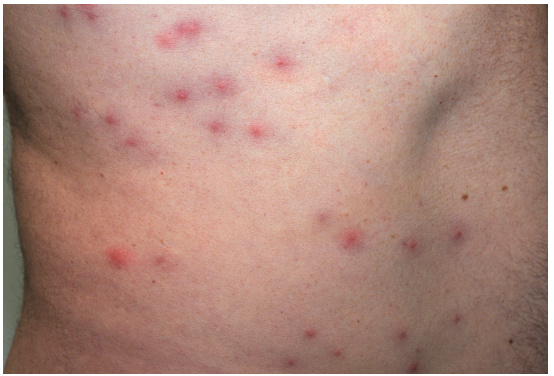 Viêm nang lông do Pseudomonas