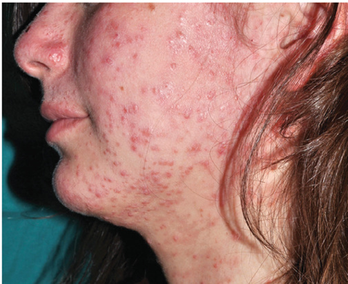 Viêm nang lông do Demodex