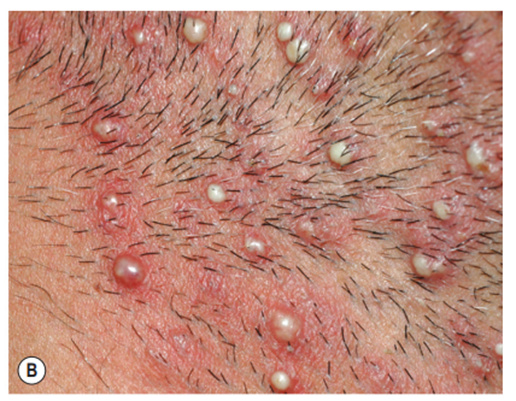 Viêm nang lông tăng bạch cầu ái toan