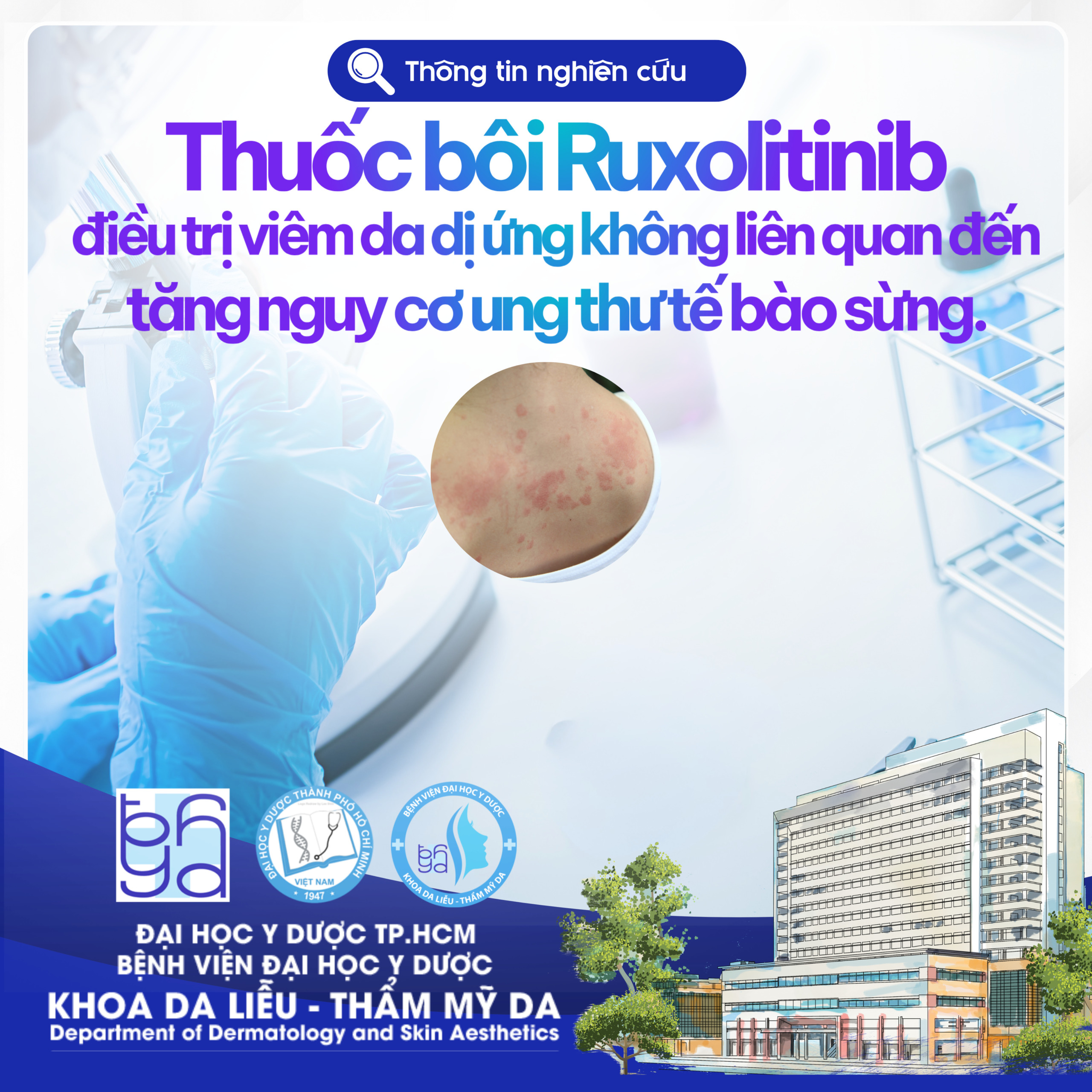 THÔNG TIN NGHIÊN CỨU: THUỐC BÔI RUXOLITINIB ĐIỀU TRỊ VIÊM DA DỊ ỨNG KHÔNG LIÊN QUAN ĐẾN VIỆC TĂNG NGUY CƠ UNG THƯ TẾ BÀO SỪNG.Tính an toàn của kem ruxolitinib 1,5% ở bệnh nhân viêm da cơ địa là thuận lợi và tương đương với bệnh nhân dùng dupilumab hoặc corticosteroid bôi ngoài da, cũng như bệnh nhân chưa từng điều trị trước đó.